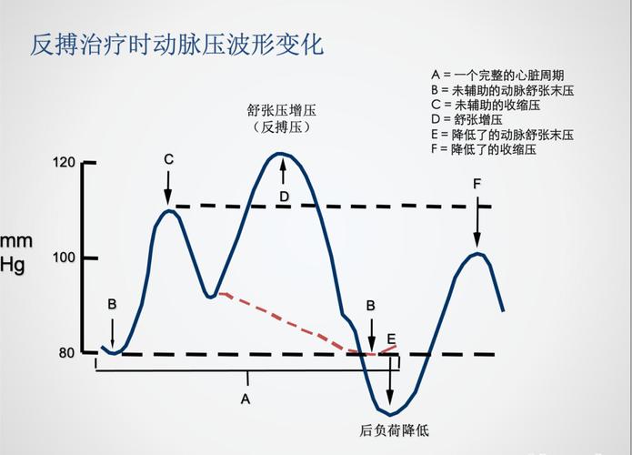 学术文章｜刘彤：IABP的适应症_患者_心肌 学术文章｜刘彤：IABP的适应症_患者_心肌 科学